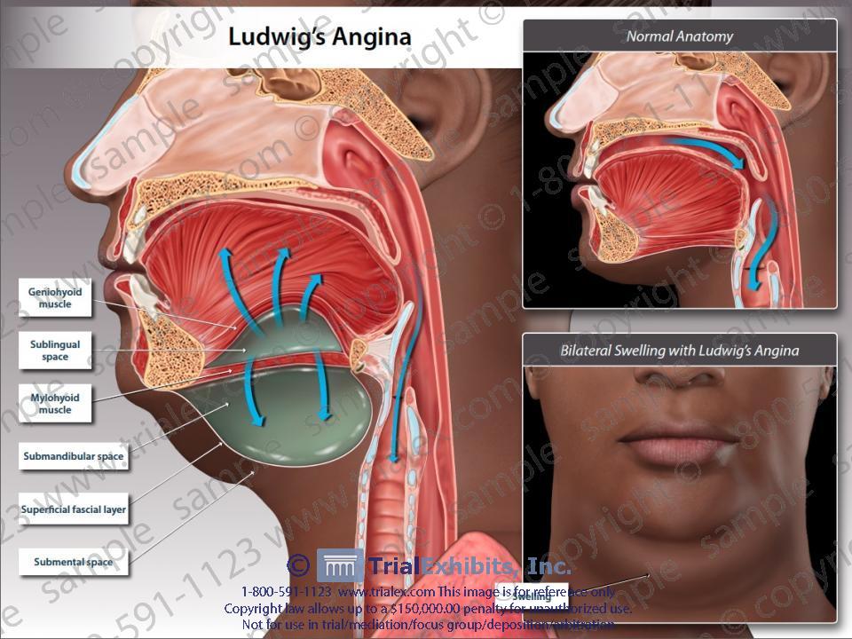 ludwigs-angina-4.jpg