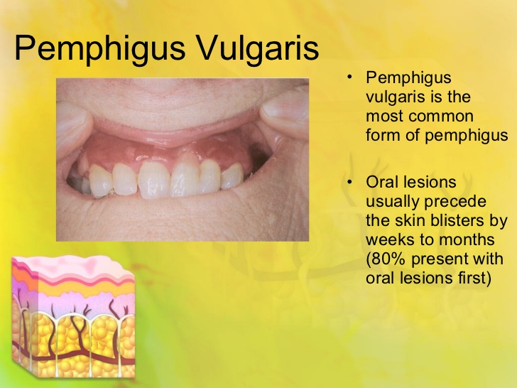 pemphigus-vulgaris-3-728.jpg
