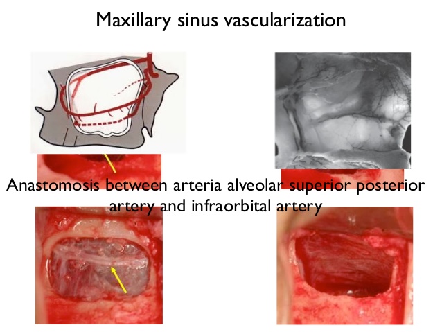 sinus-lift-and-immediate-implant-placement-5-638.jpg