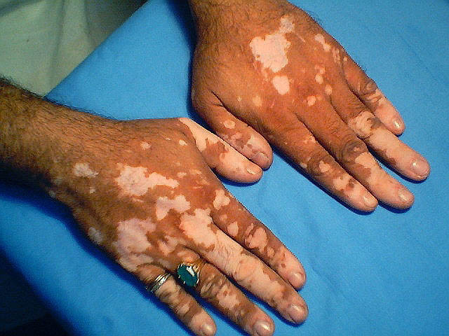 vitiligo_fingers_0.jpg