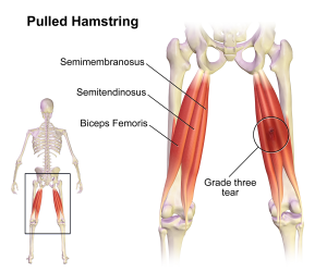Pulled_Hamstring_2016102908344882e.png